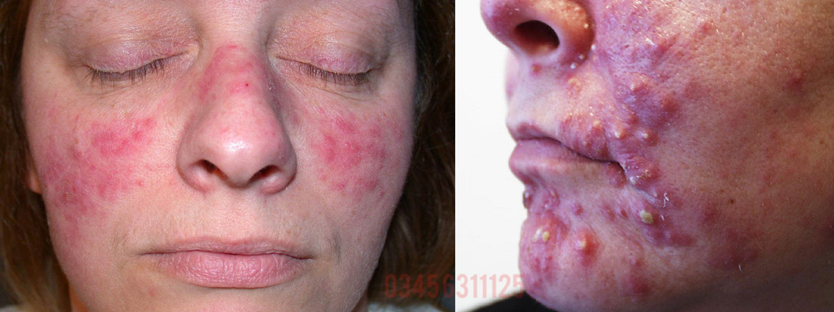 Acne Causes, Symptoms and Treatment