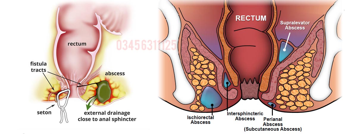 Anal Fistula Causes, Symptoms and Treatment