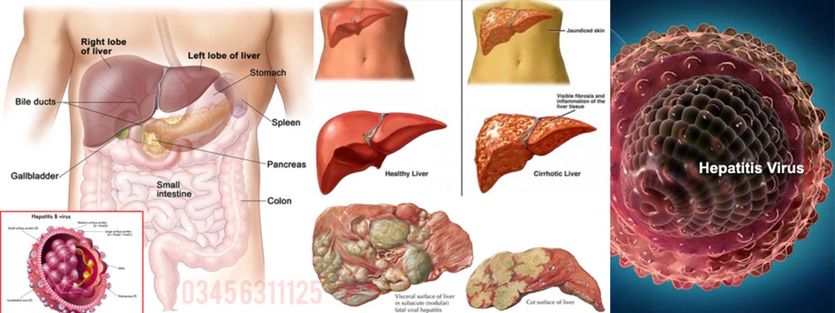 Hepatitis Causes, Symptoms and Treatment