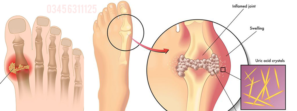High Uric Acid Causes, Symptoms and Treatment