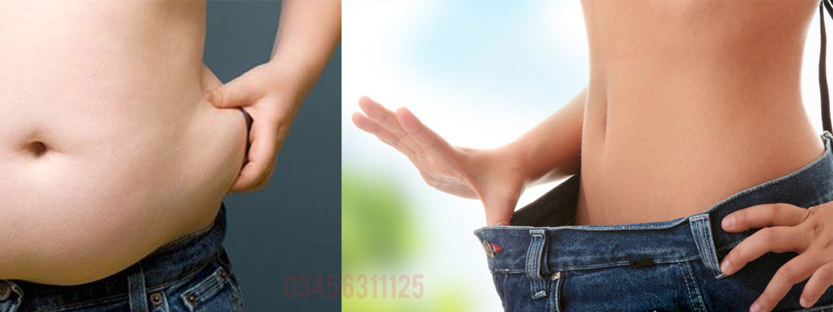 Obesity Causes, Symptoms and Treatment