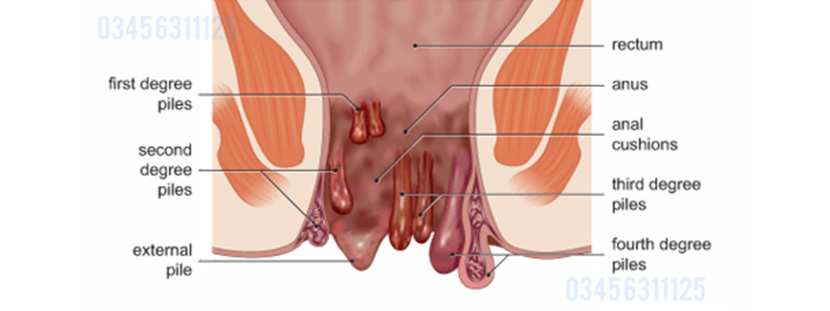 Piles Causes, Symptoms and Treatment