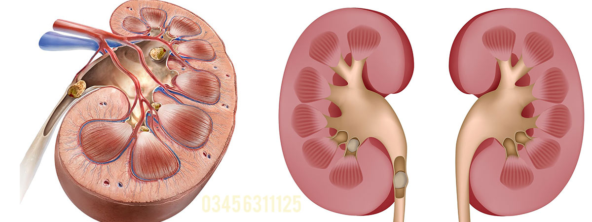 Kidney Stones Causes, Symptoms and Treatment