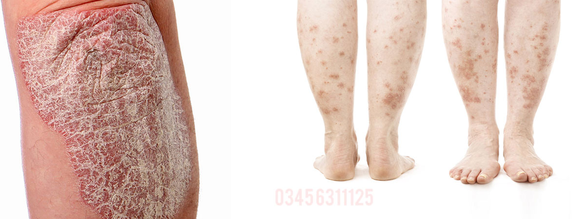 Psoriasis Causes, Symptoms and Treatment